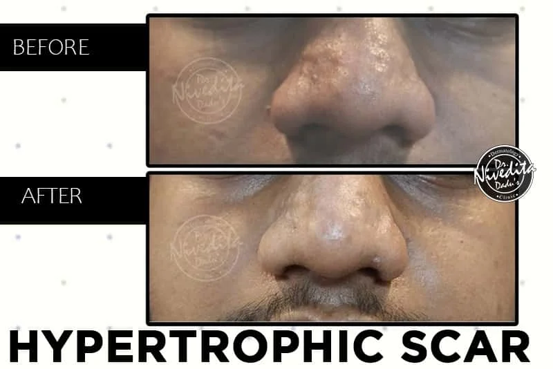 Hypertropics scars