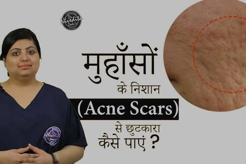 Plasma Induction Therapy for Acne Scars
