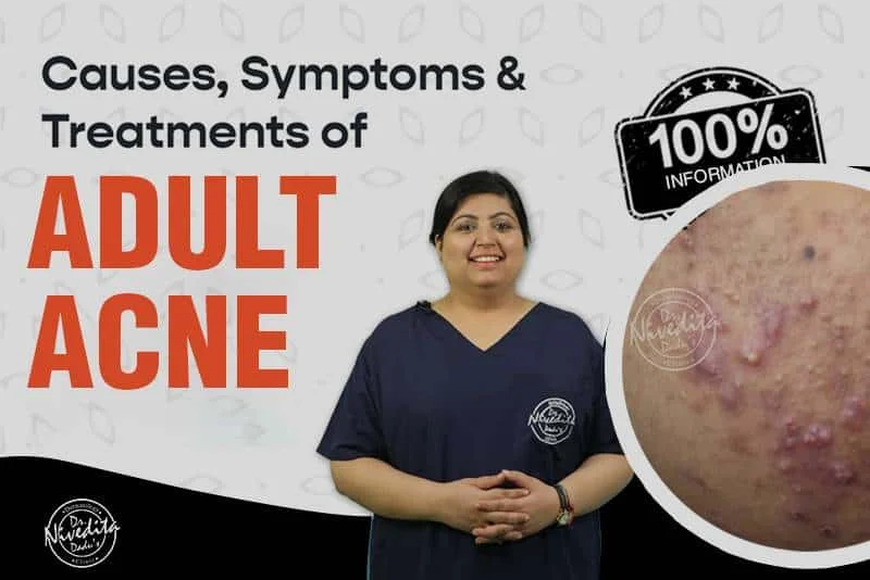 Adult Acne Symptoms