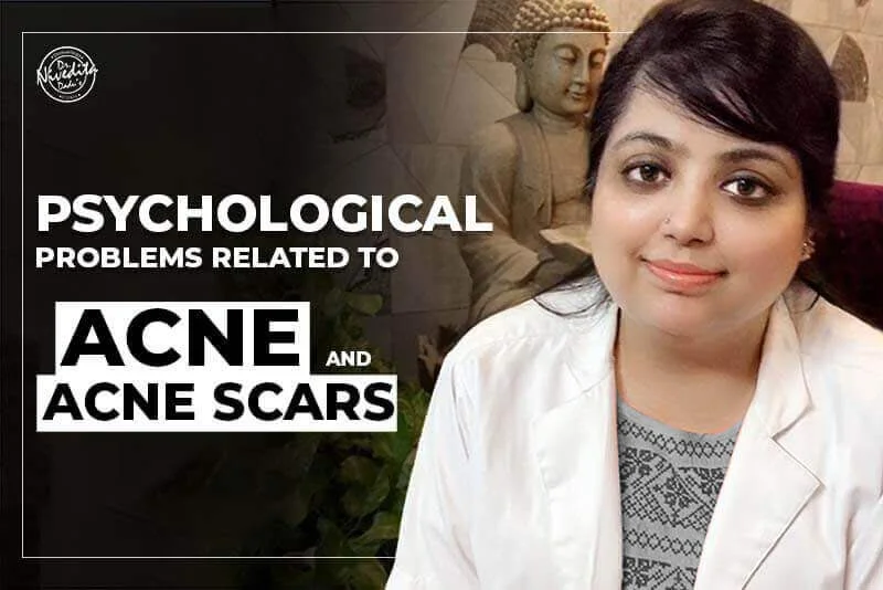 Psychological problems related to Acne..