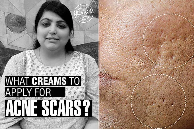 Acne Scar Removal Creams