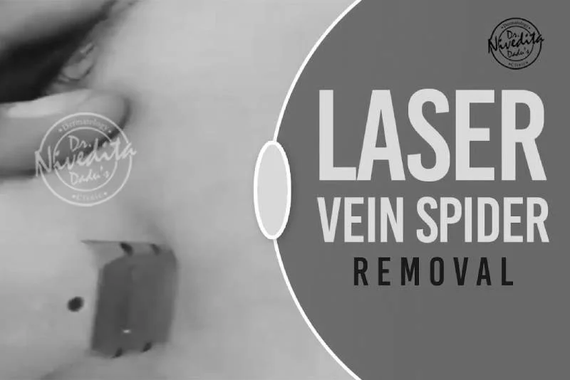 Spider Veins Treatment | Laser Treatment