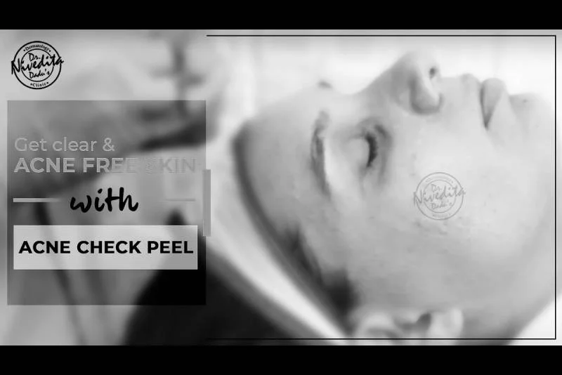 Pimples मुहासे ठीक करने का सबसे अच्छा इलाज | How to cure acne | Get Clear and Acne Free Skin