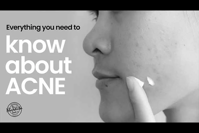 Everything you need to know about ACNE | Acne: Types & Treatment