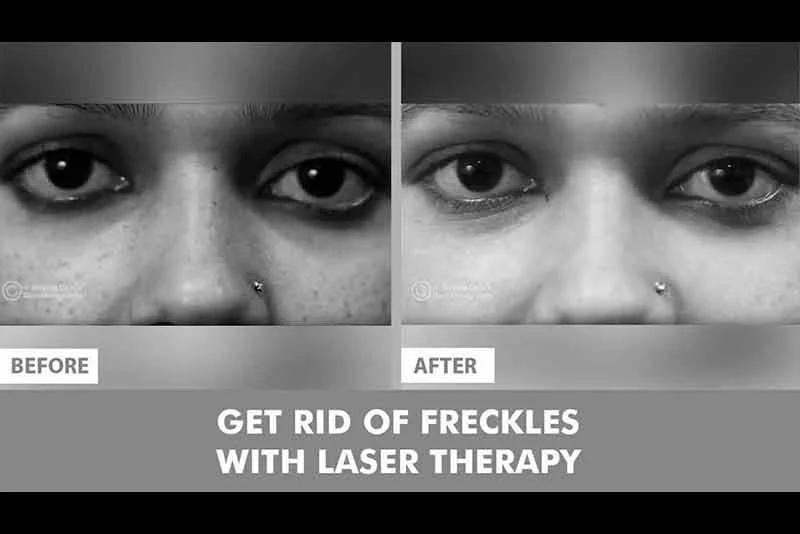 How to Get Rid of Freckles with Laser Treatment