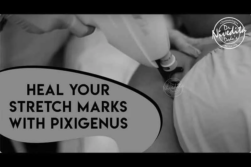 Best Stretch Marks Removal Laser Treatment - Pixigenus