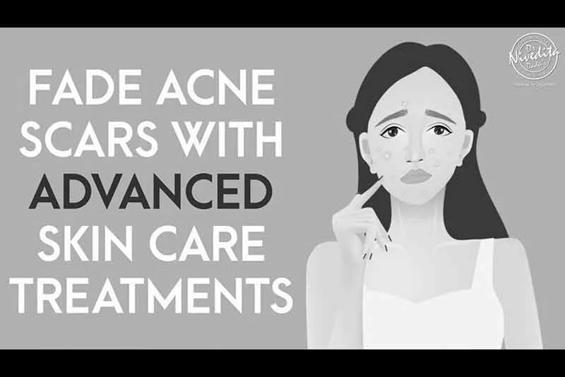 चेहरे की झाइयां, दाग, धब्बे दूर करे | Fade Acne Scars with Advanced Skin Care Treatment