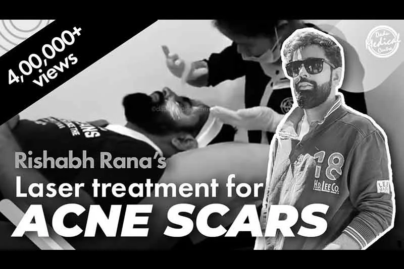 Advance Laser Treatments for Acne Scars | @Rishhsome Laser Removal Treatment for Acne Scar
