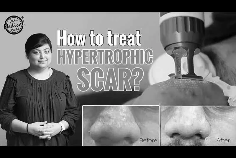 How To Treat Hypertrophic Scar? | Hypertrophic Acne Scar | Bumps on Nose | Dr. Nivedita Dadu
