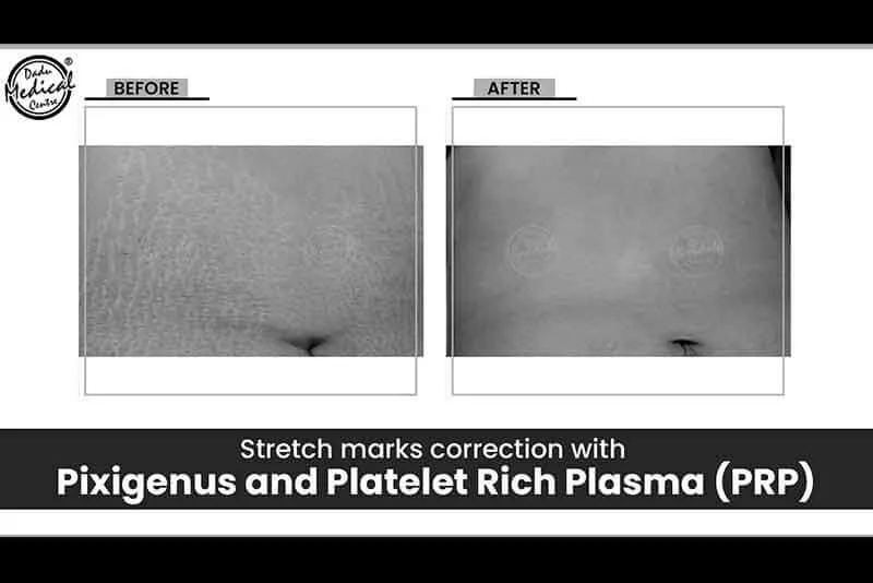 Get your Stretch Marks Removed within no time | OMG Unbelievable Results
