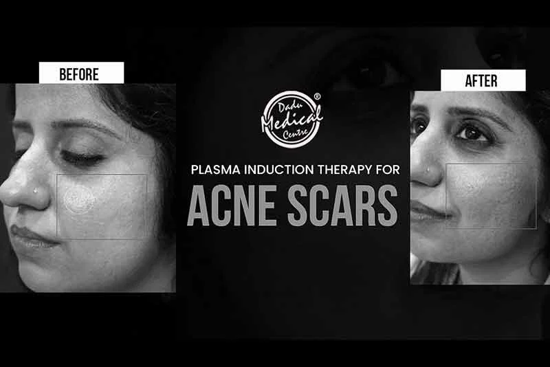 Plasma Induction Therapy for ACNE SCAR | Dr. Nivedita Dadu's Dermatology Clinic
