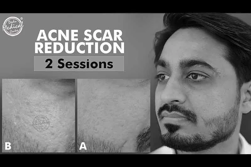 How to treat Acne Scar on face in just 2 Sessions