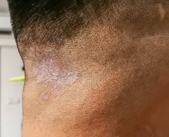 Contact Dermatitis Treatment in Delhi