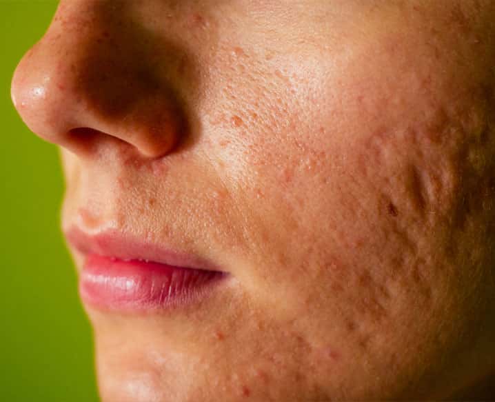 Pixigenus Laser for Acne Scar Reduction in Delhi