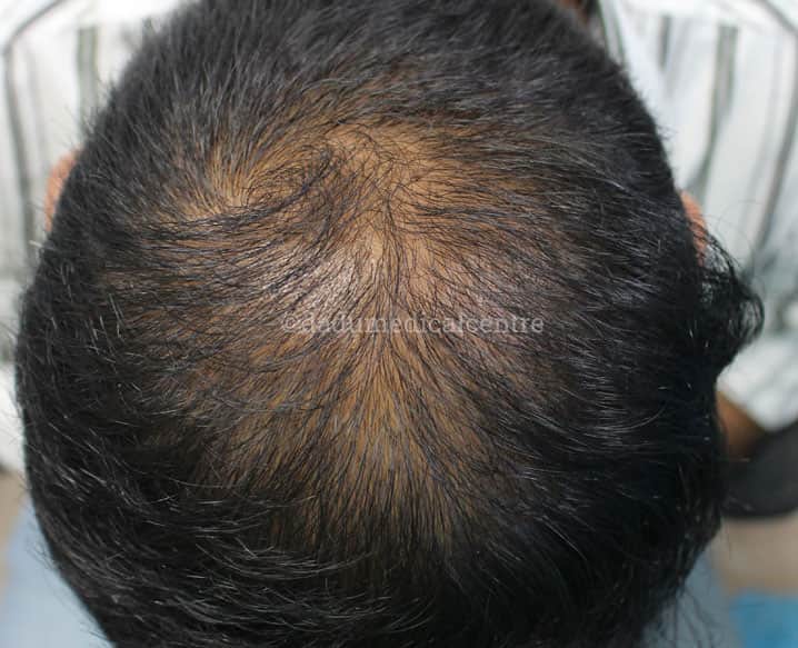 Alopecia Areata Treatment in Delhi