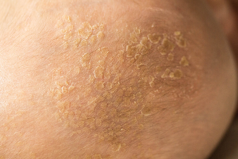 Seborrheic Dermatitis Treatment in Delhi
