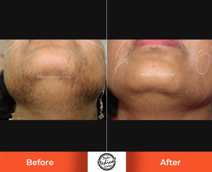 Real Results | Before and After Photos of Unwanted Hair Removal Treatment