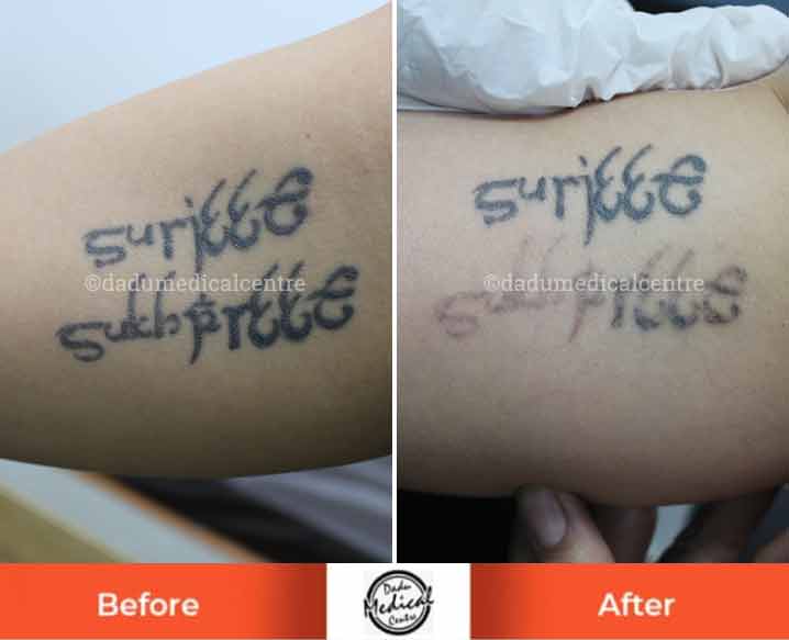 Parmanent Tattoo Removal Treatment  Laser Tattoo Removal in Kadapa   Bangalore