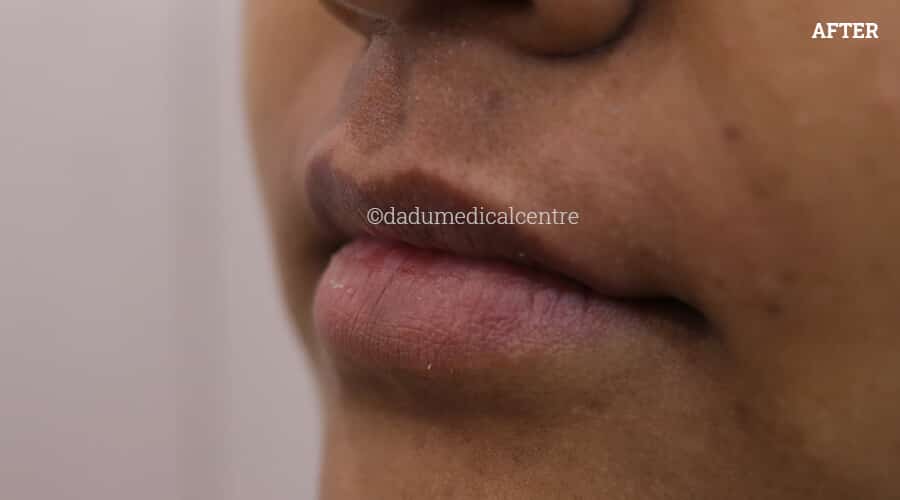 Real Results | Before and After Photos of Upper Lip Laser Hair Reduction  Treatment