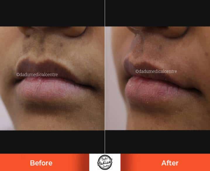 Real Results | Before and After Photos of Upper Lip Laser Hair Reduction  Treatment