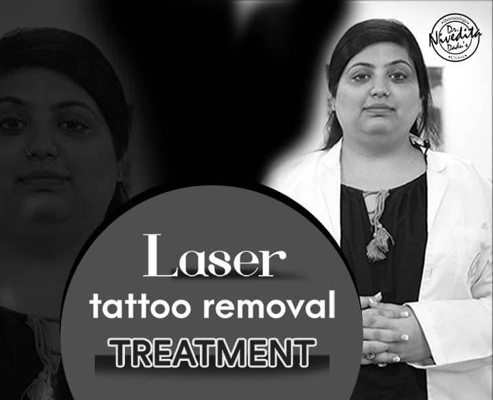 Can Lasers Remove Tattoos Completely  Laser Tattoo Removal